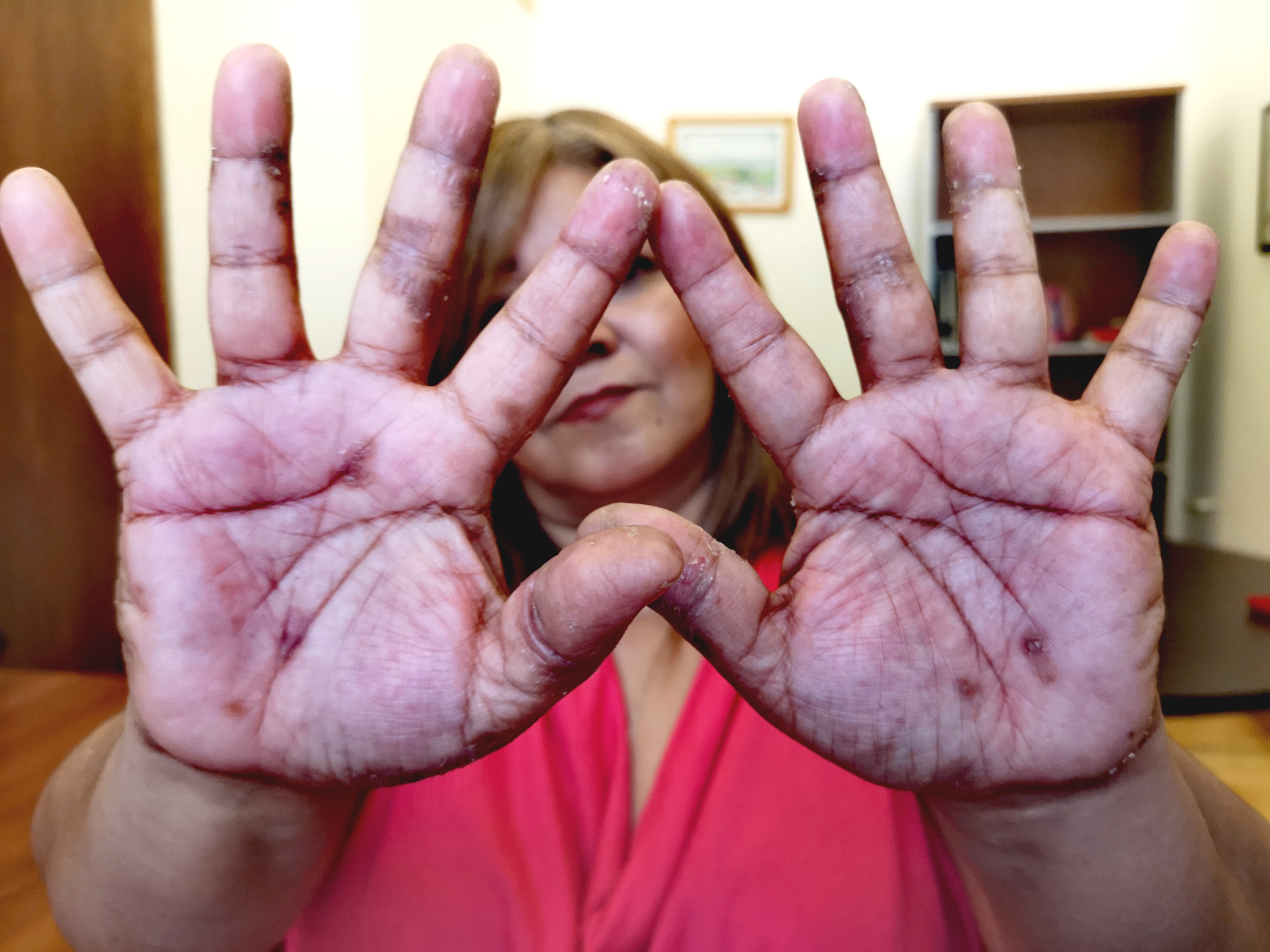 Maribel aus einer Gemeinde in der Nähe der Kupfermine zeigt die Symptome der Hautkrankheiten an Händen und Füßen
